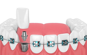 Брекеты и имплантация