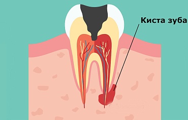 Можно ли вылечить кисту зуба?